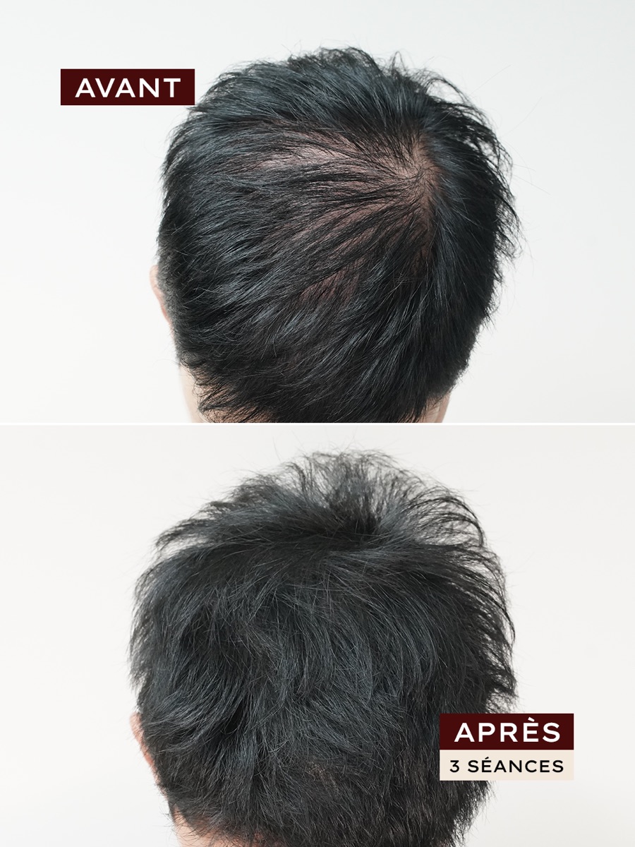 Avant / après · densification homme, 3 séances